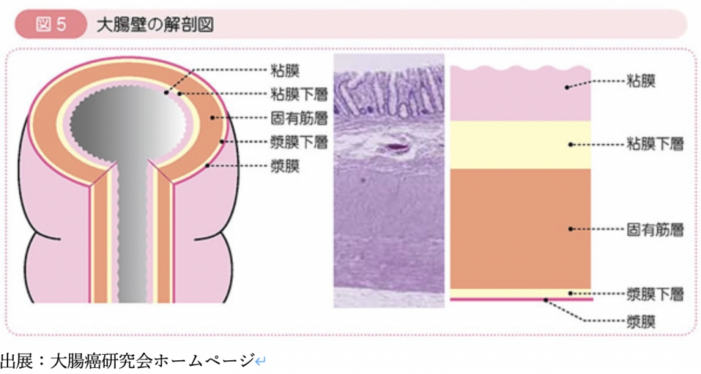 大腸癌の発生と進展