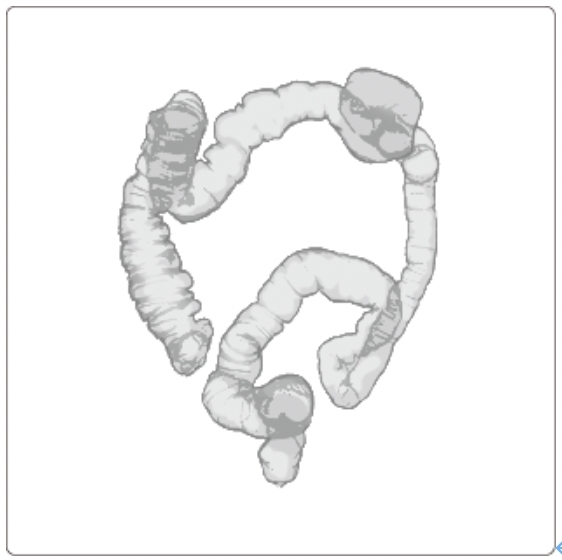 大腸癌の診断のための検査