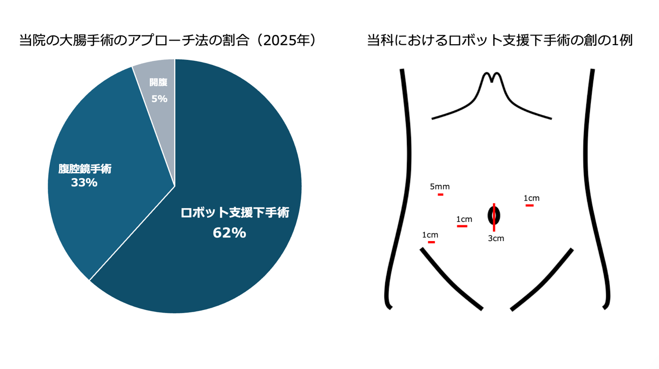 当科における手術・実績紹介｜慶應義塾大学腸班